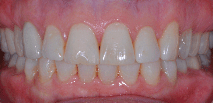 After treatment results