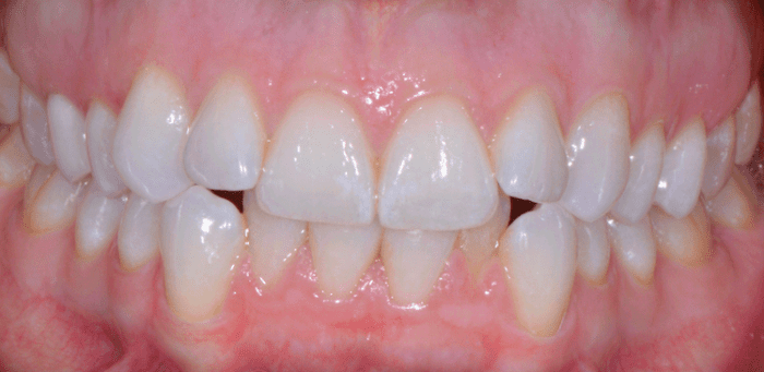 before dental treatment results