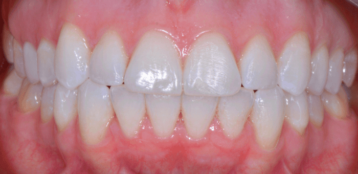 After treatment results