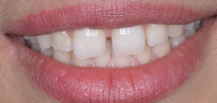 before dental treatment results